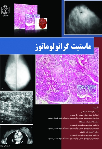 ماستیت گرانولوماتوز